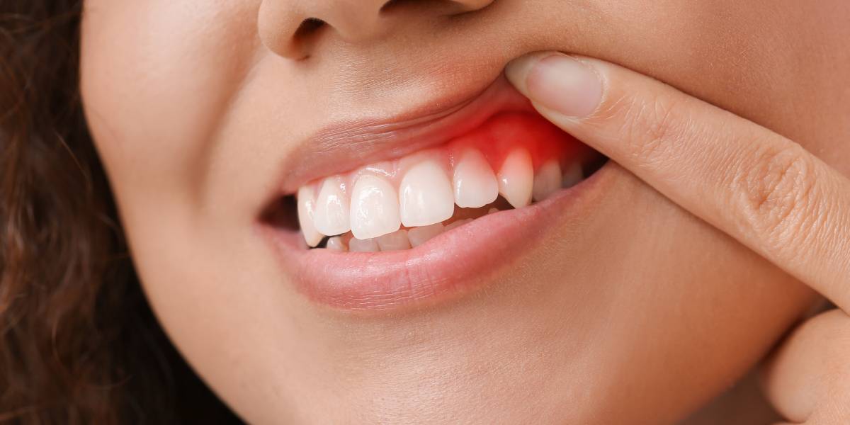 Top Tips for Avoiding Gum Disease and Maintaining a Beautiful Smile