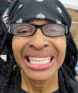 Smile in a day after photo Case 51