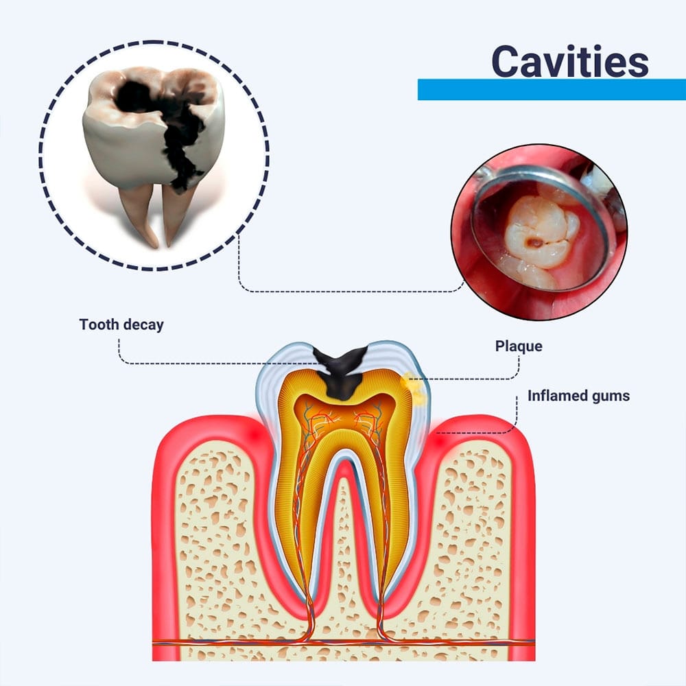 Cavities