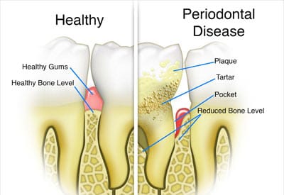 Periodontal Disease Infographics