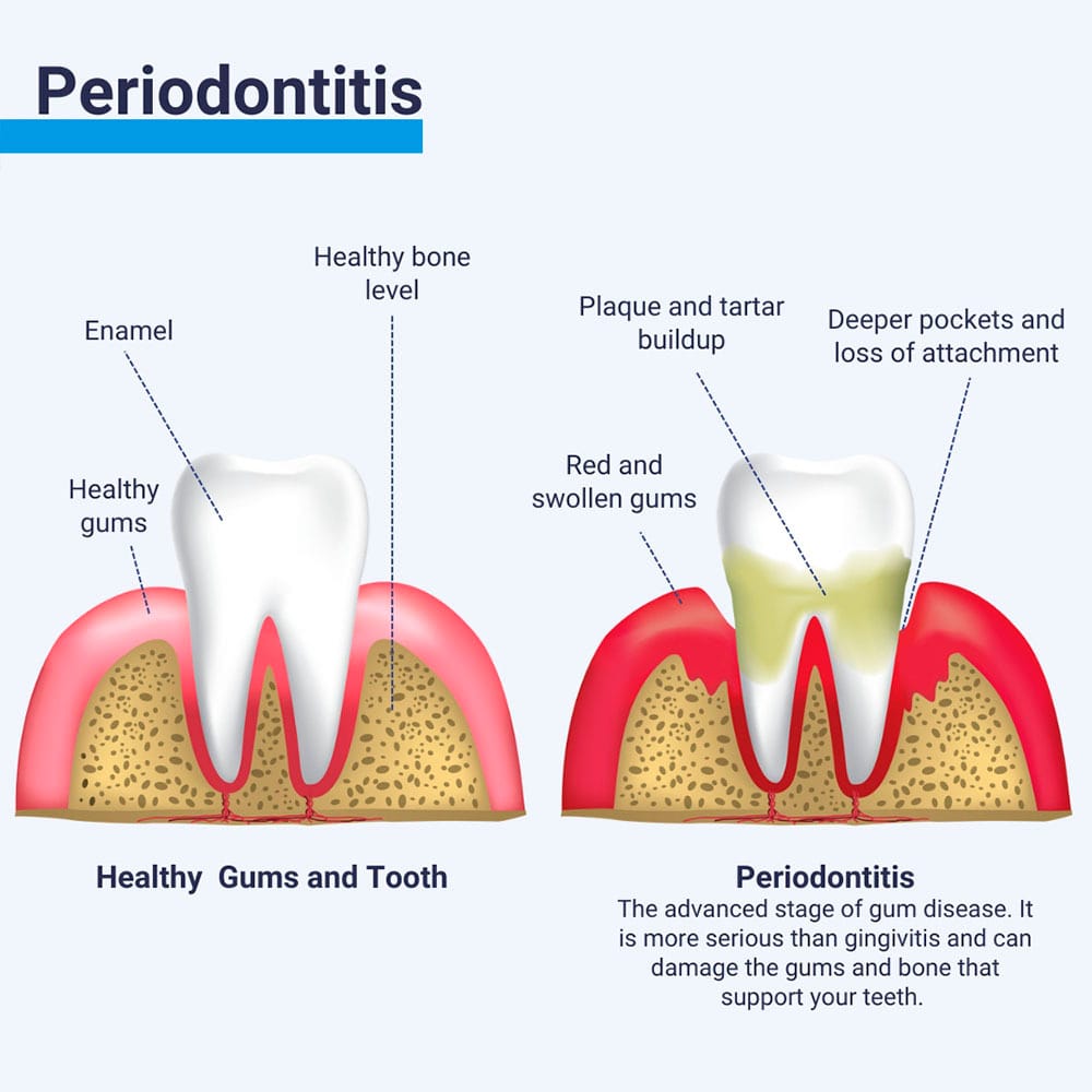 Periodontitis