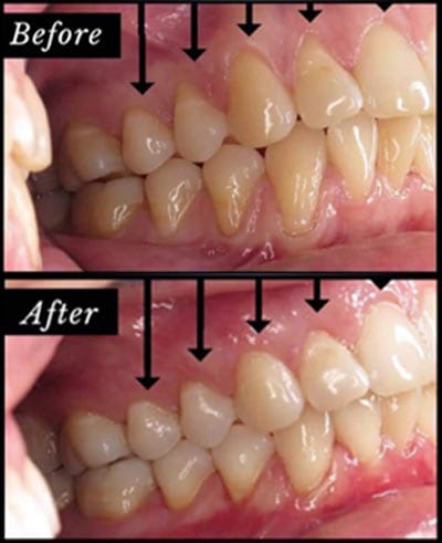 Pinhole Surgery for Gum Recession Before After
