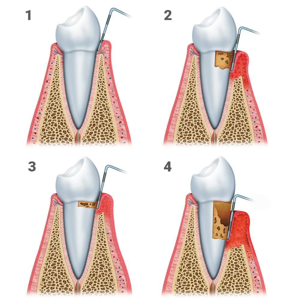 Stages of Gum Disease