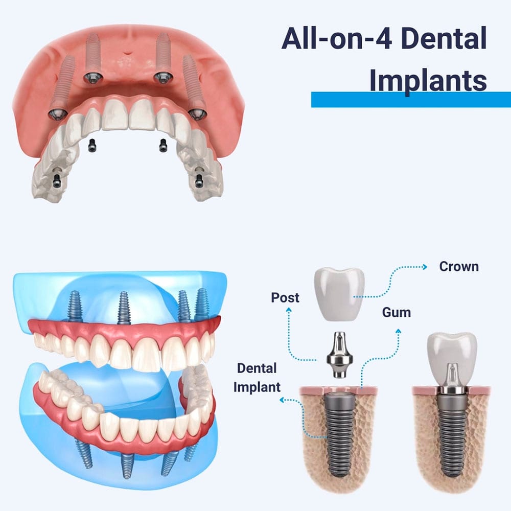 All-on-4 Dental Implants