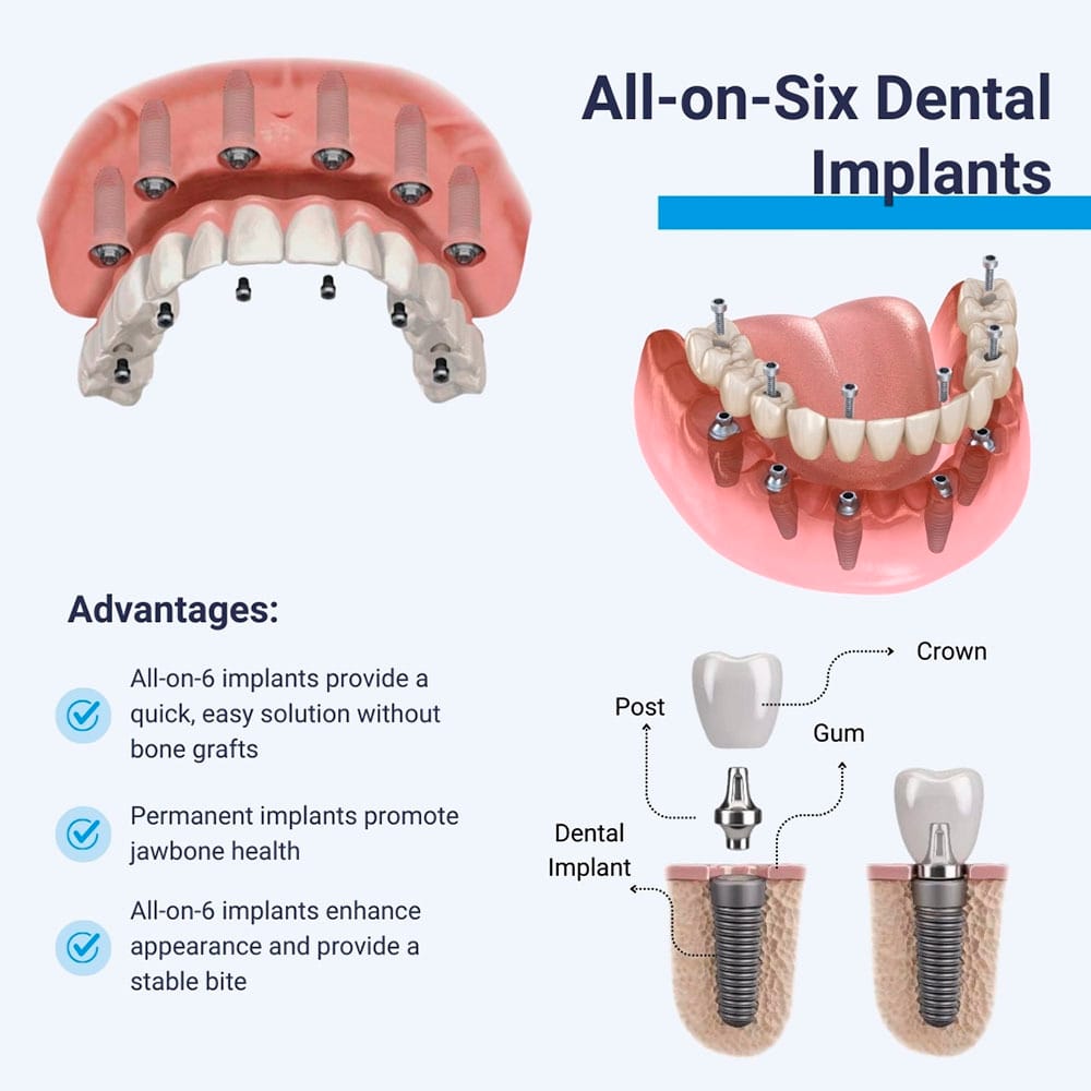 All-on-6 Dental Implants