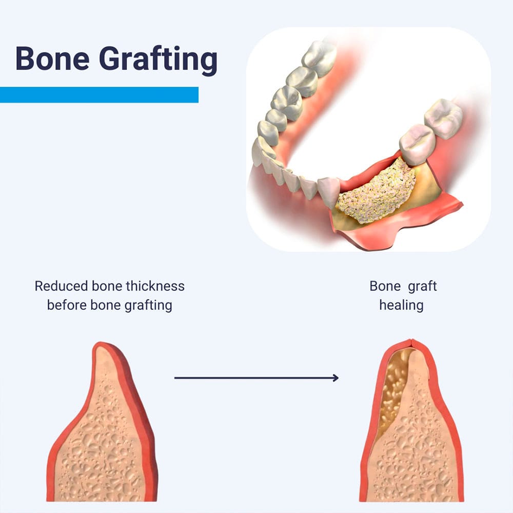 Bone Grafting