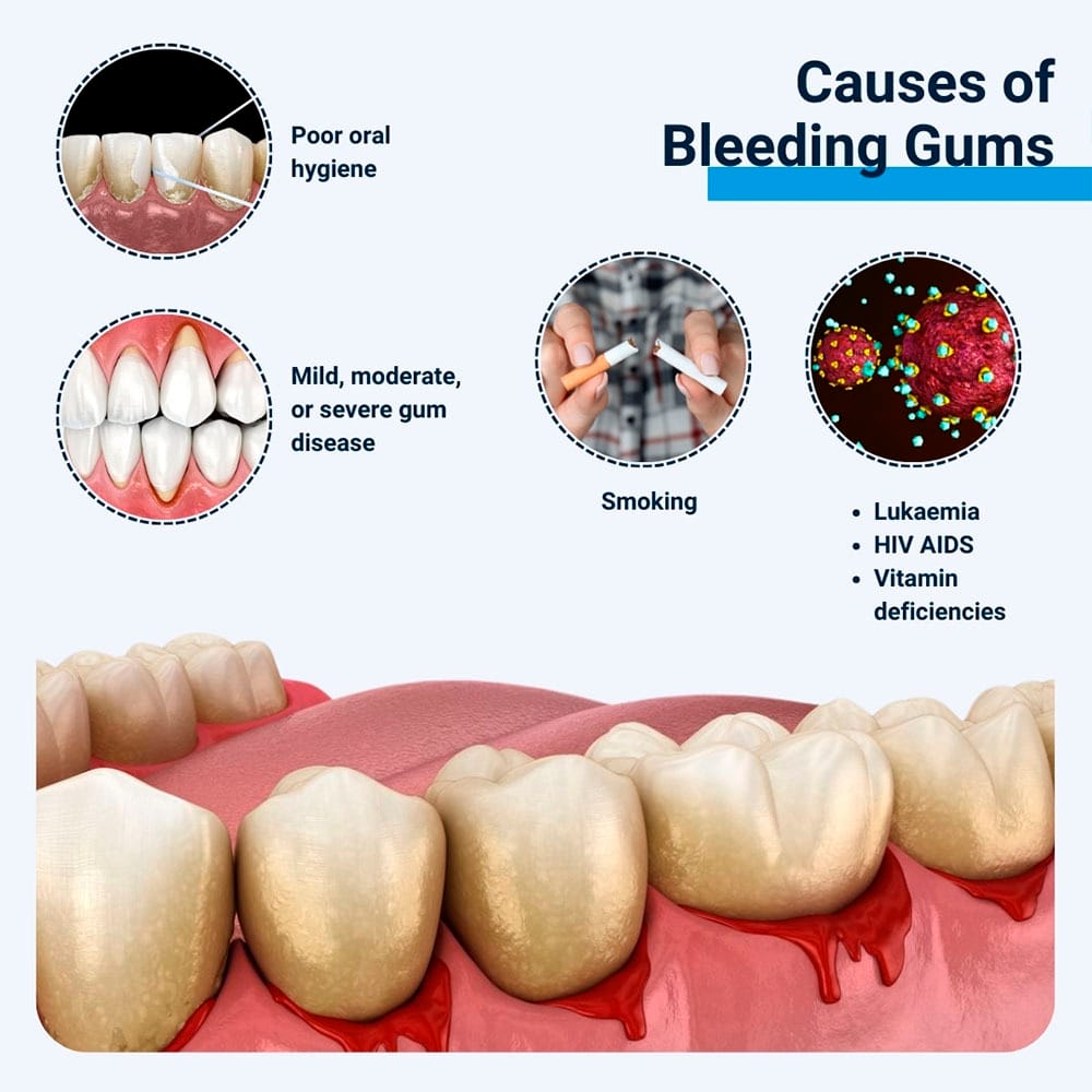 Causes of Bleeding Gums