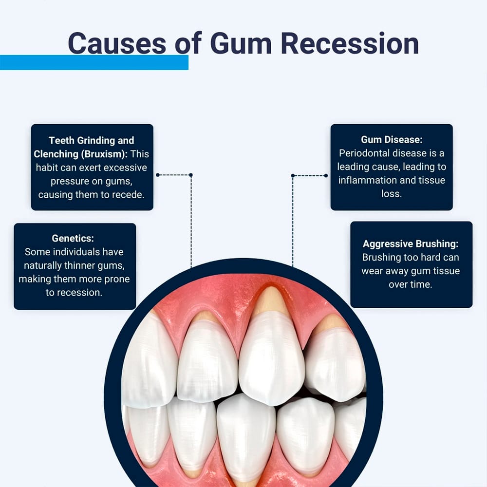 Causes of Gum Recession