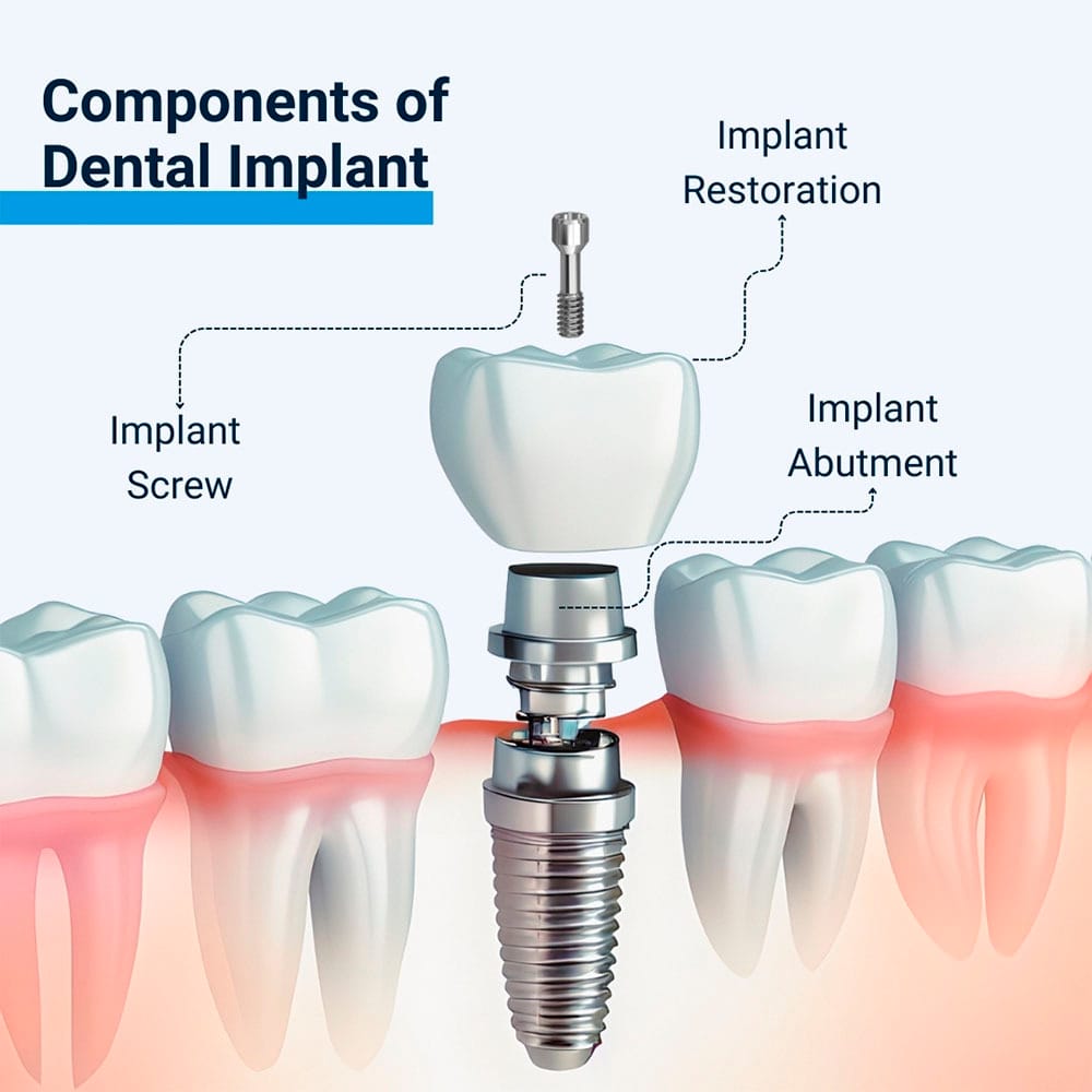 Components of Dental Implant