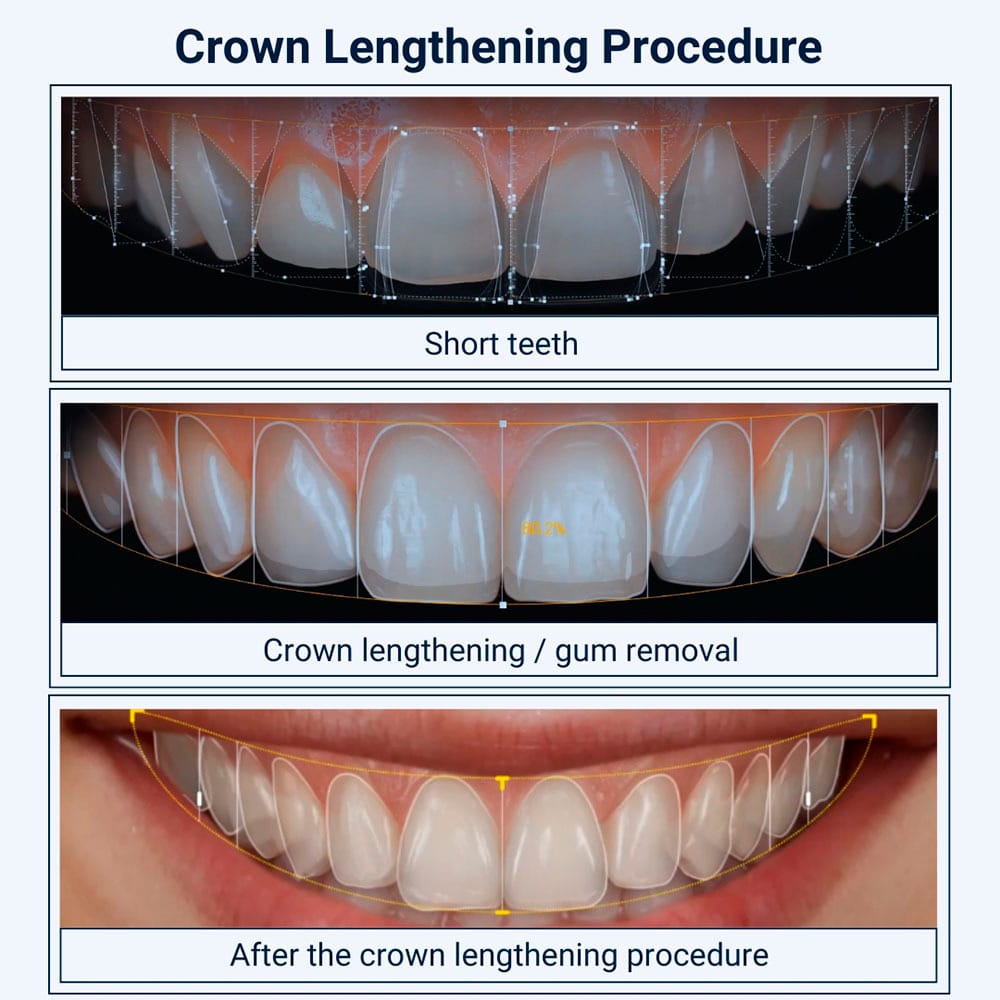 Crown Lengthening Procedure