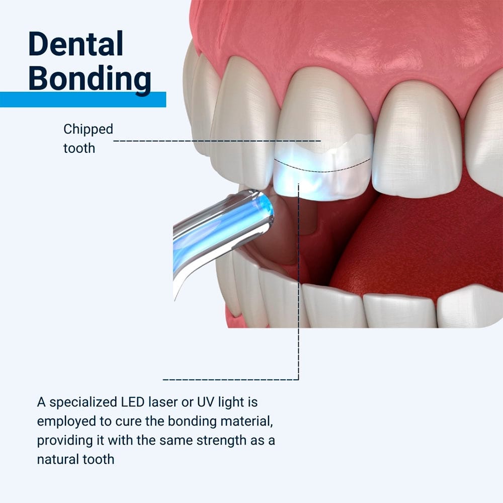 Dental Bonding