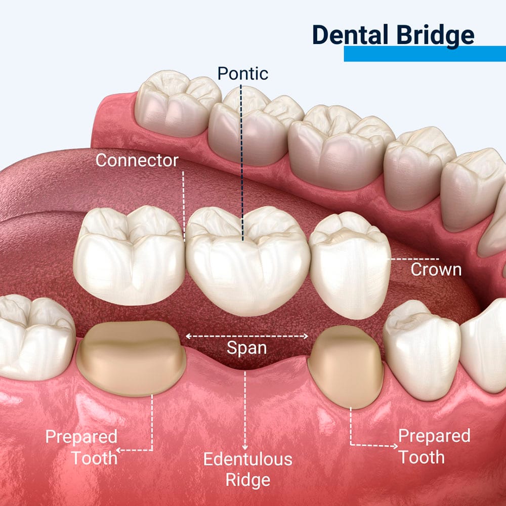 Dental Bridge