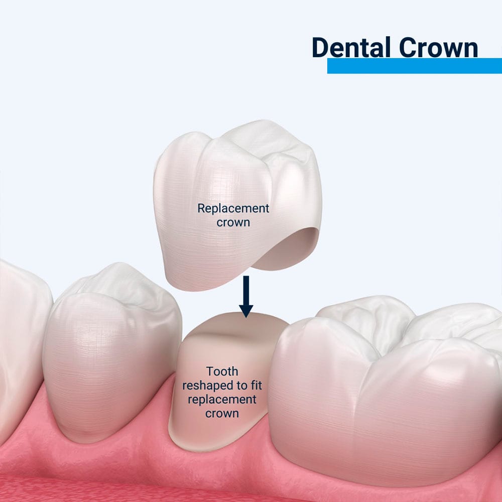 Dental Crown
