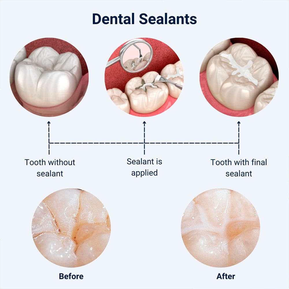 Dental Sealants
