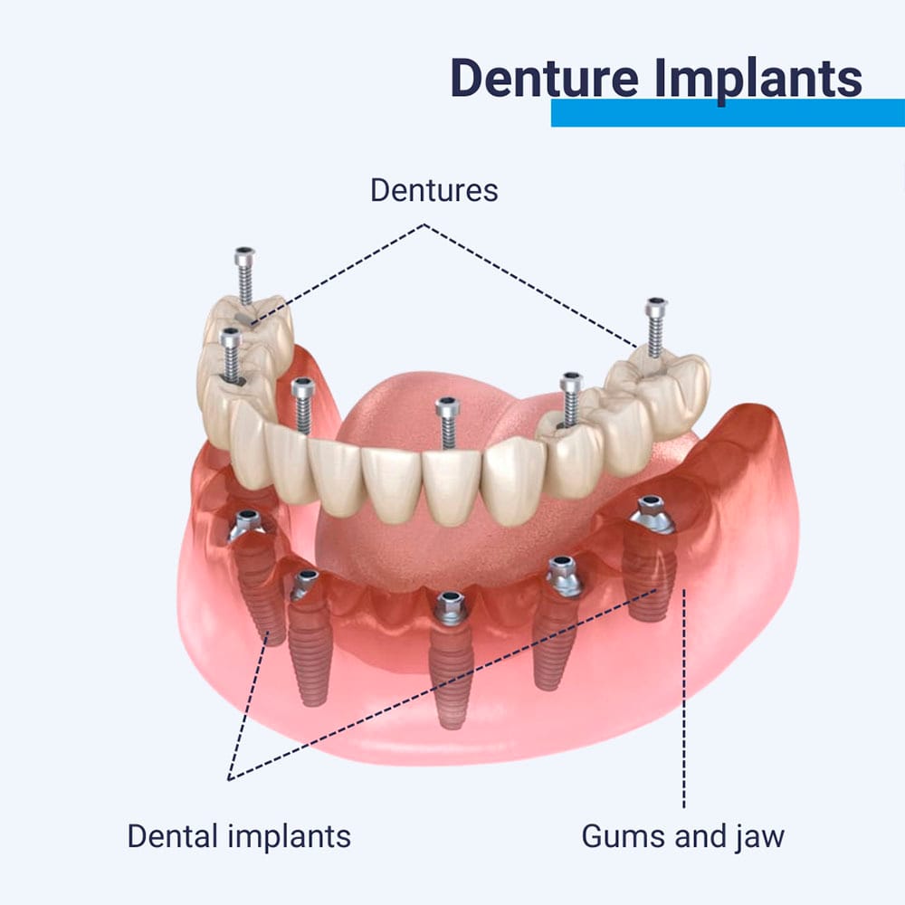 Denture Implants