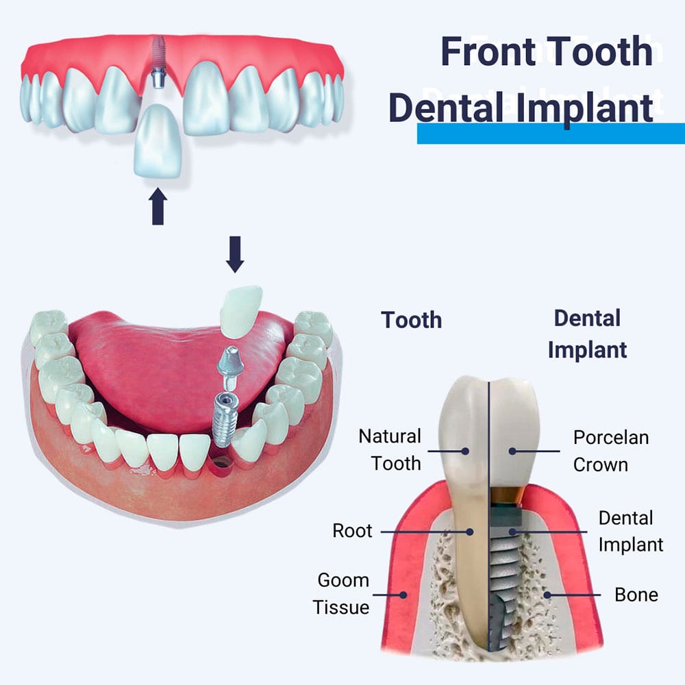 Front Tooth Dental Implants