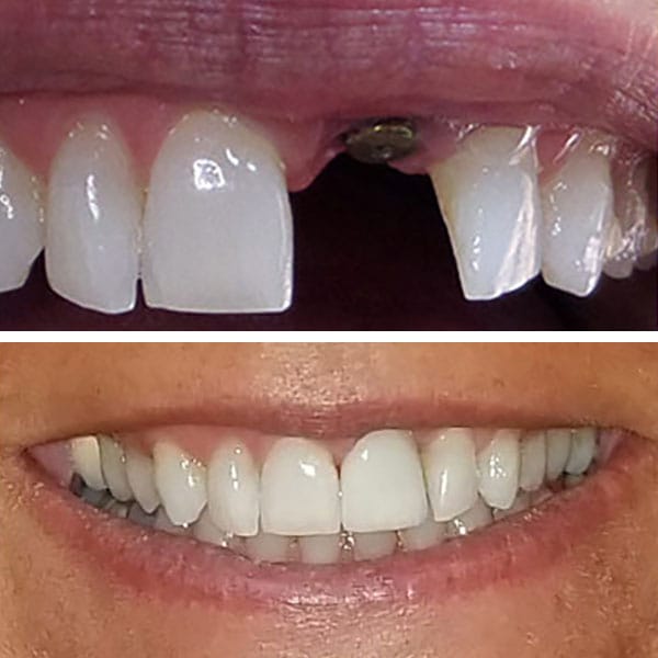 Front Tooth Implants Before and After Pictures (Case 1)