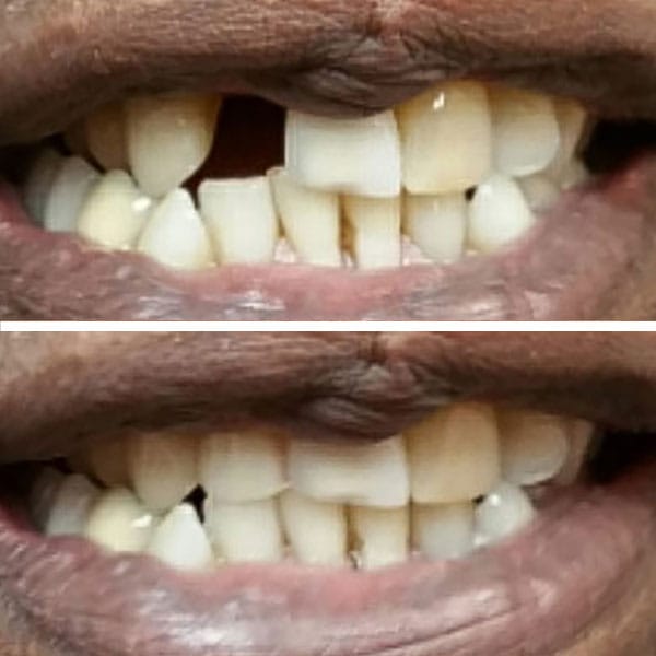 Front Tooth Implants Before and After Pictures (Case 2)