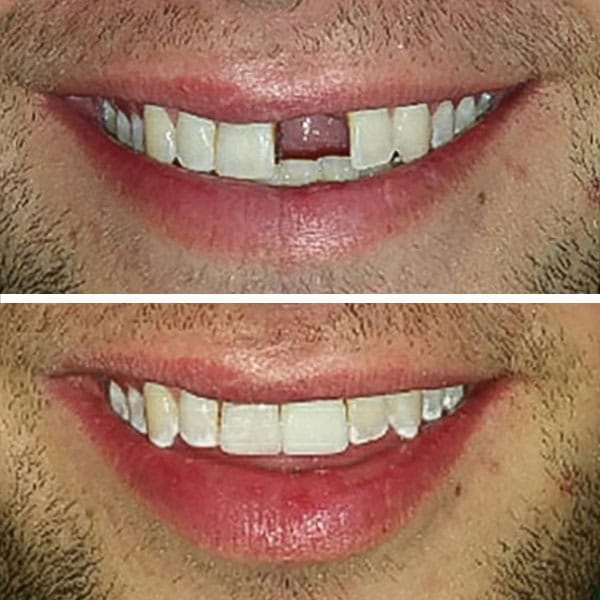 Front Tooth Implants Before and After Pictures (Case 3)
