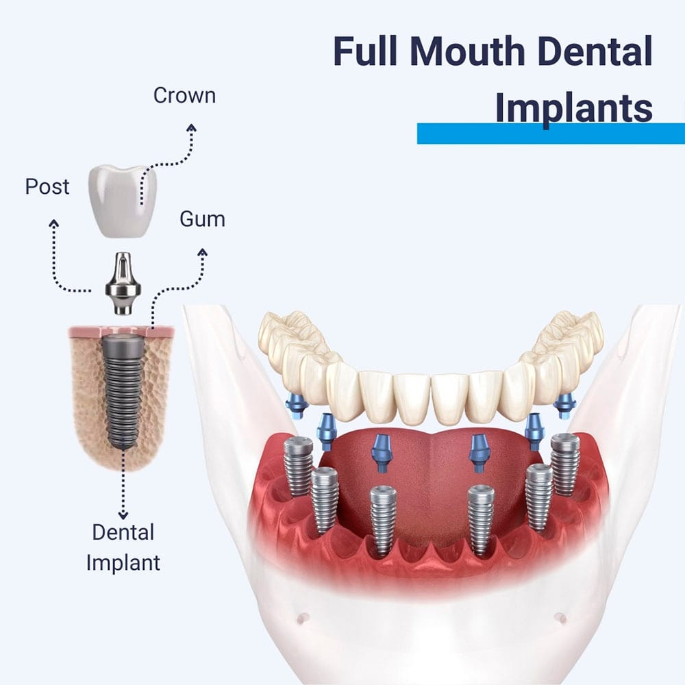 Full Mouth Implants