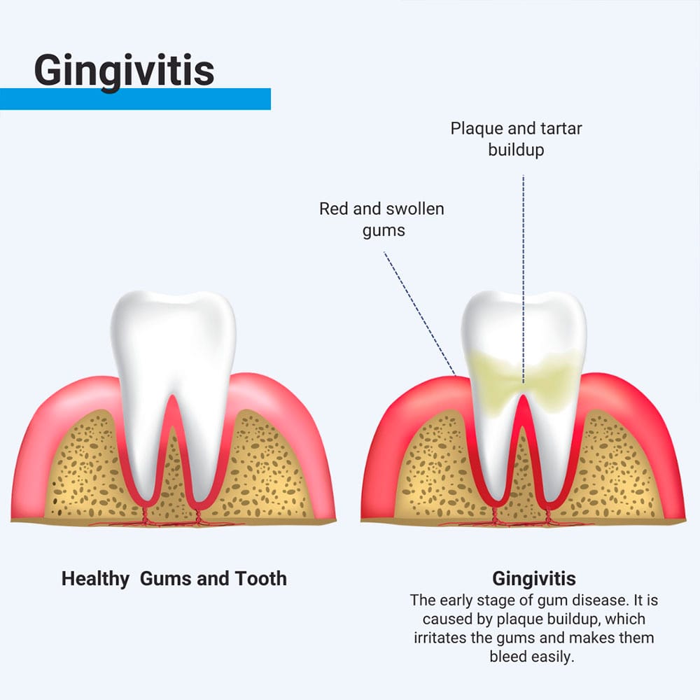 Gingivitis