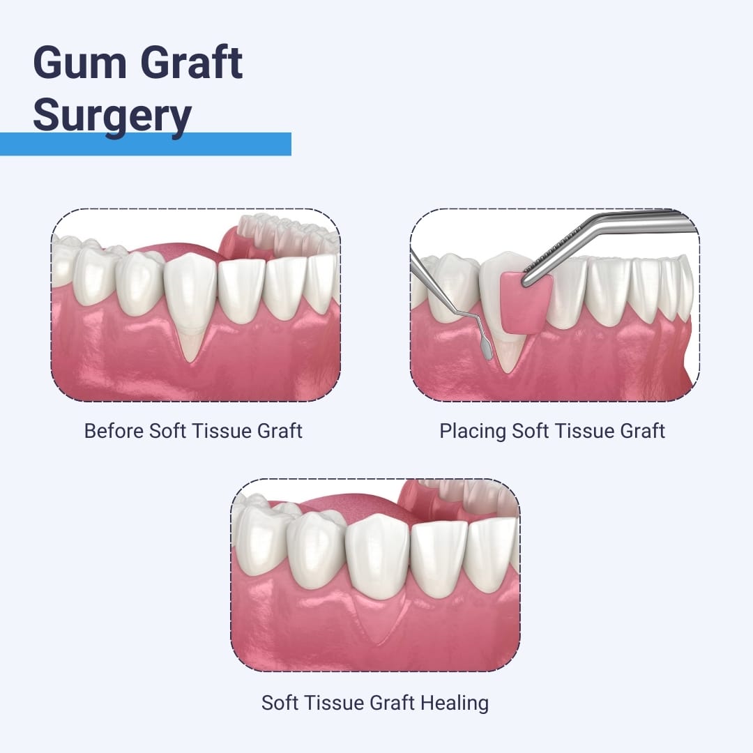 Gum Graft Surgery