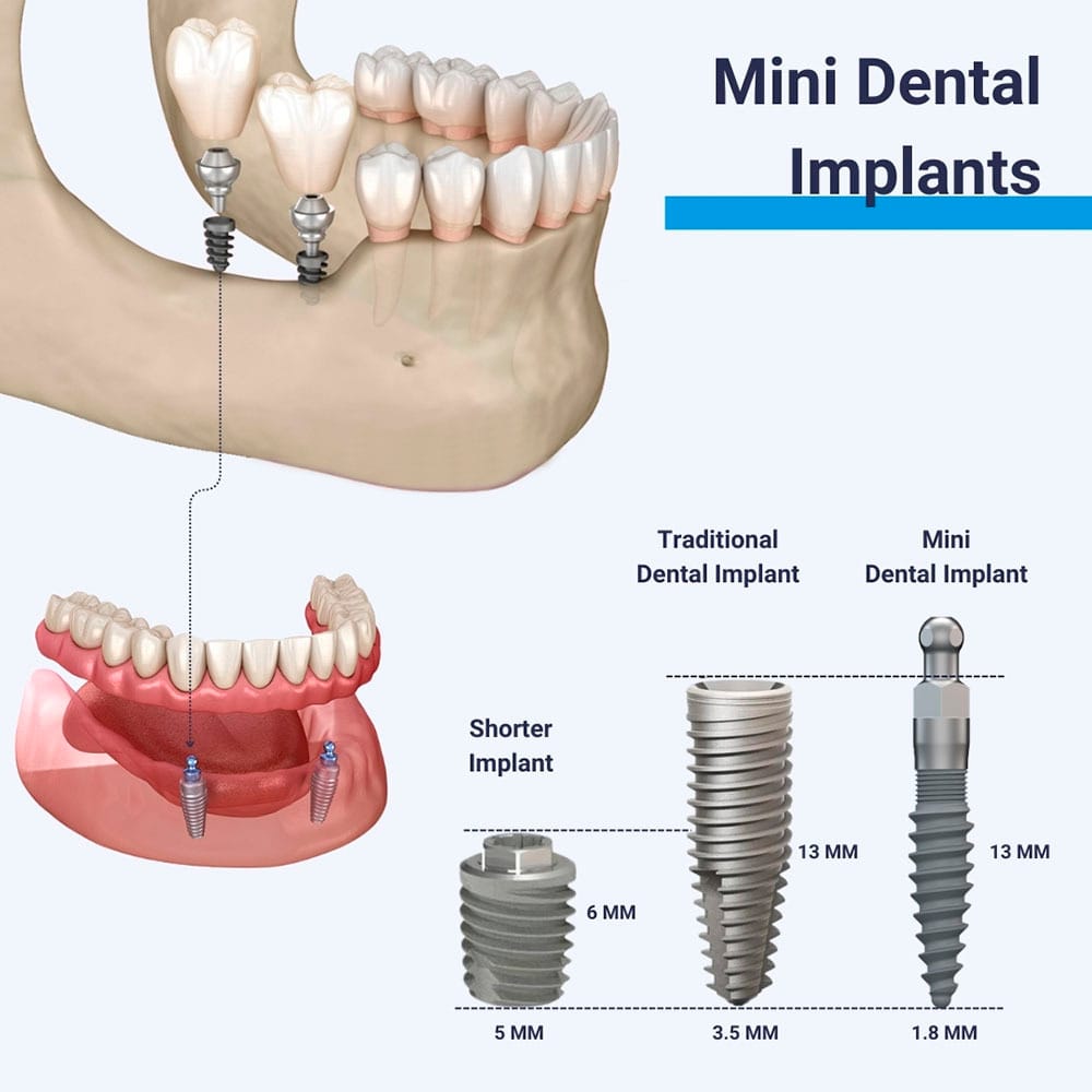 Mini Dental Implants