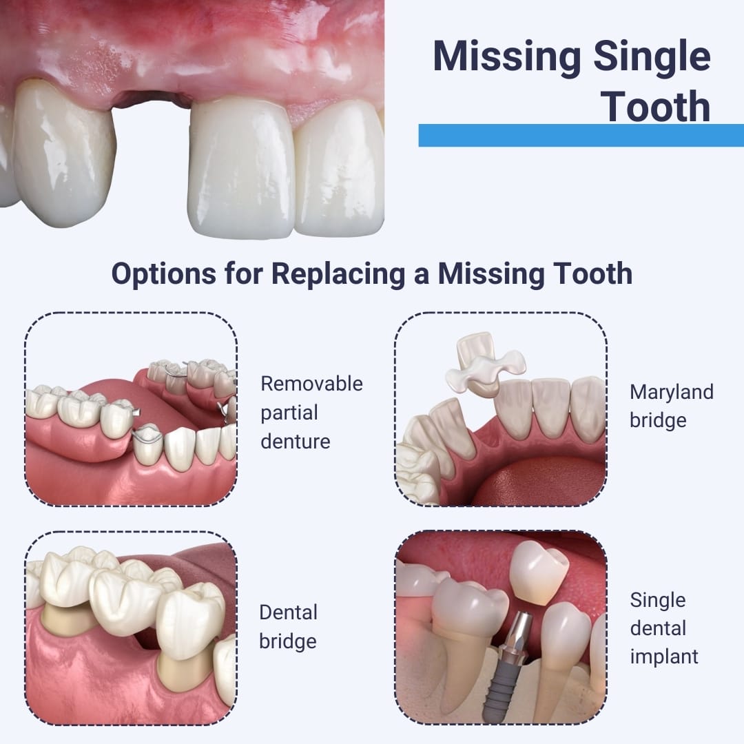 Missing Single Tooth