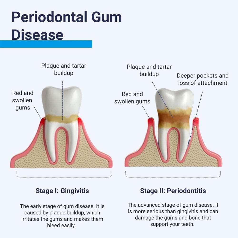 Periodontal Gum Disease
