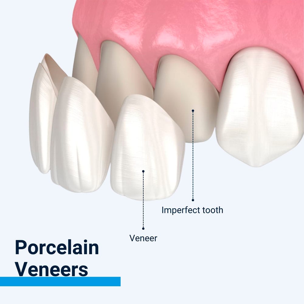 Porcelain Veneers