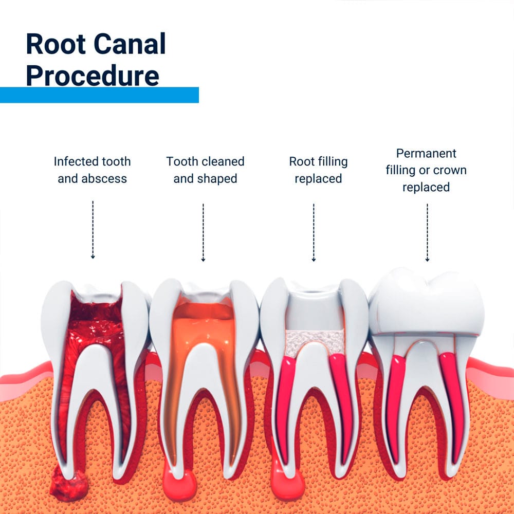 Root Canal Procedure