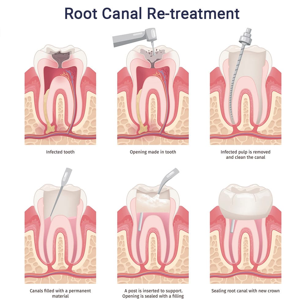 Root Canal Re-Treatment