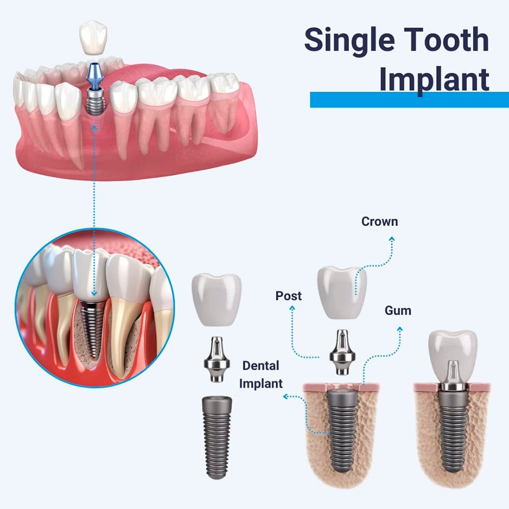 Single Tooth Implant