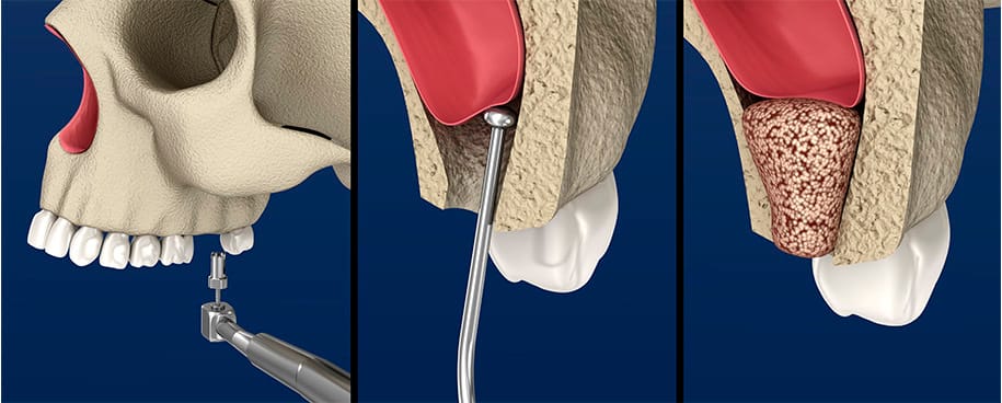 Sinus Lift Procedure