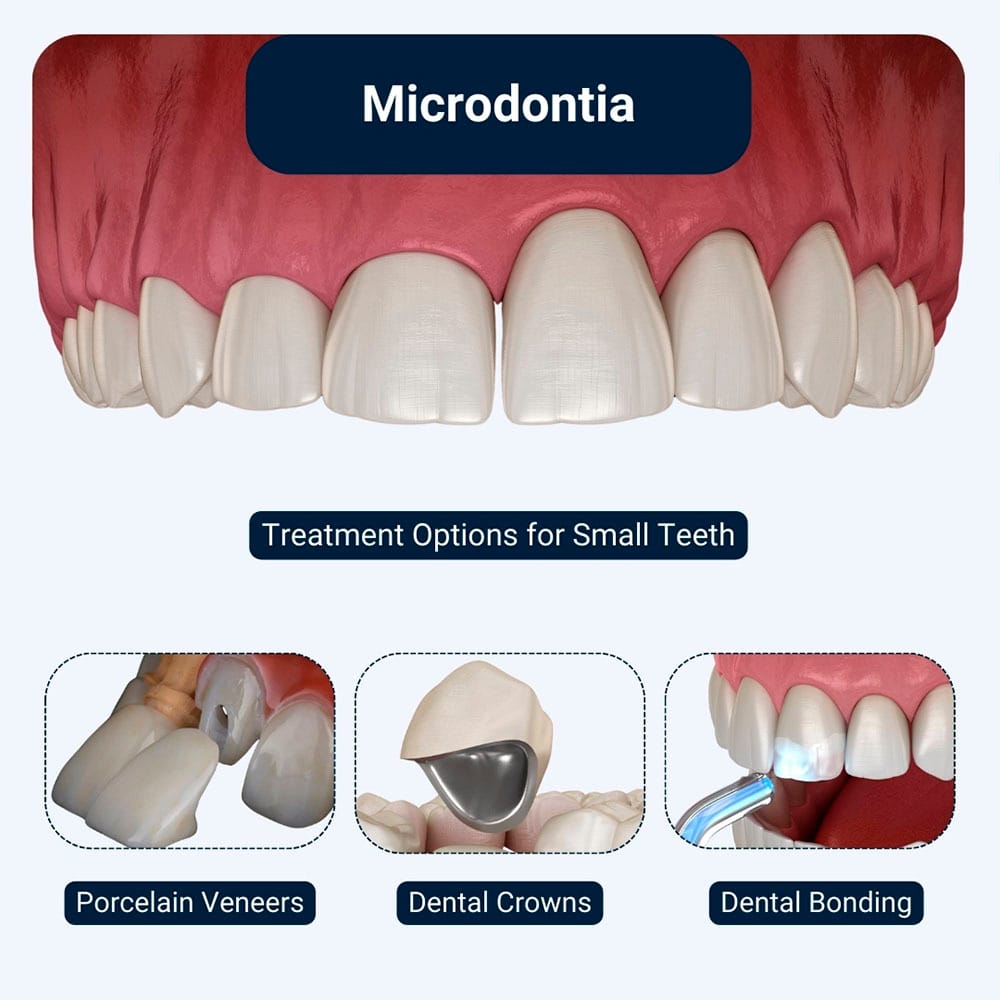 Small Teeth Microdontia