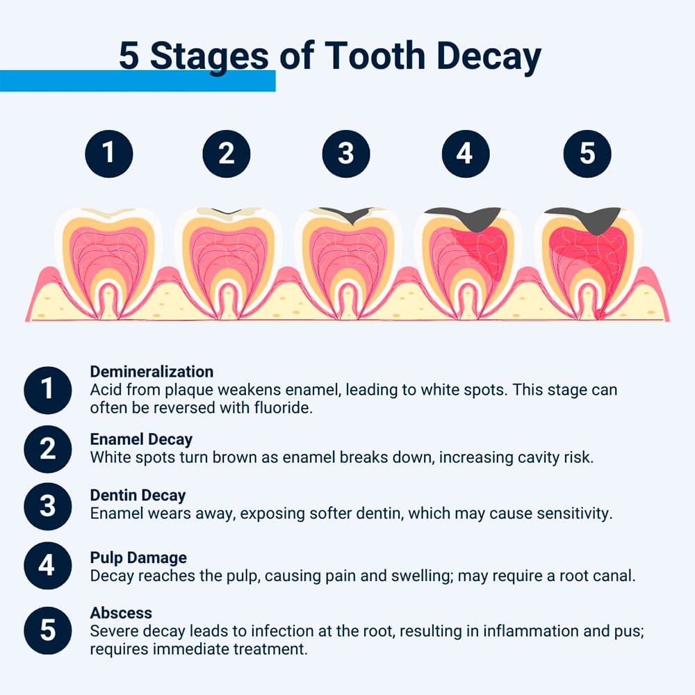 Stages ofT ooth Decay