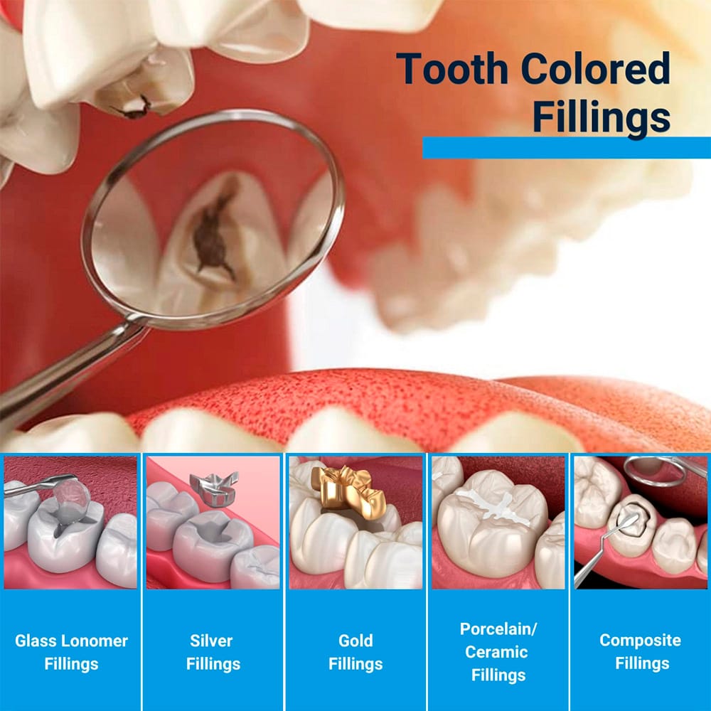 Tooth Colored Fillings