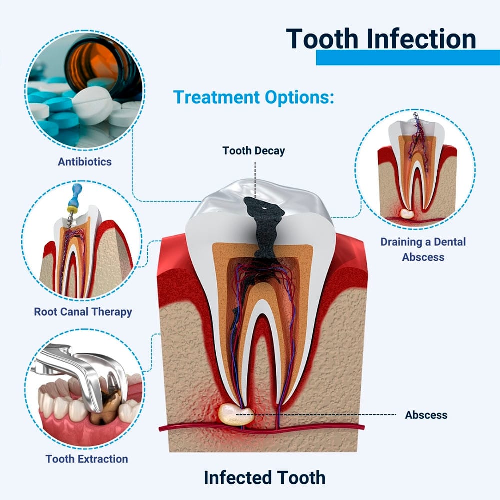 Tooth Infection