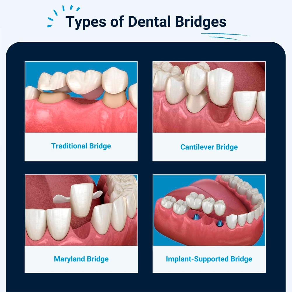 Types of Dental Bridges