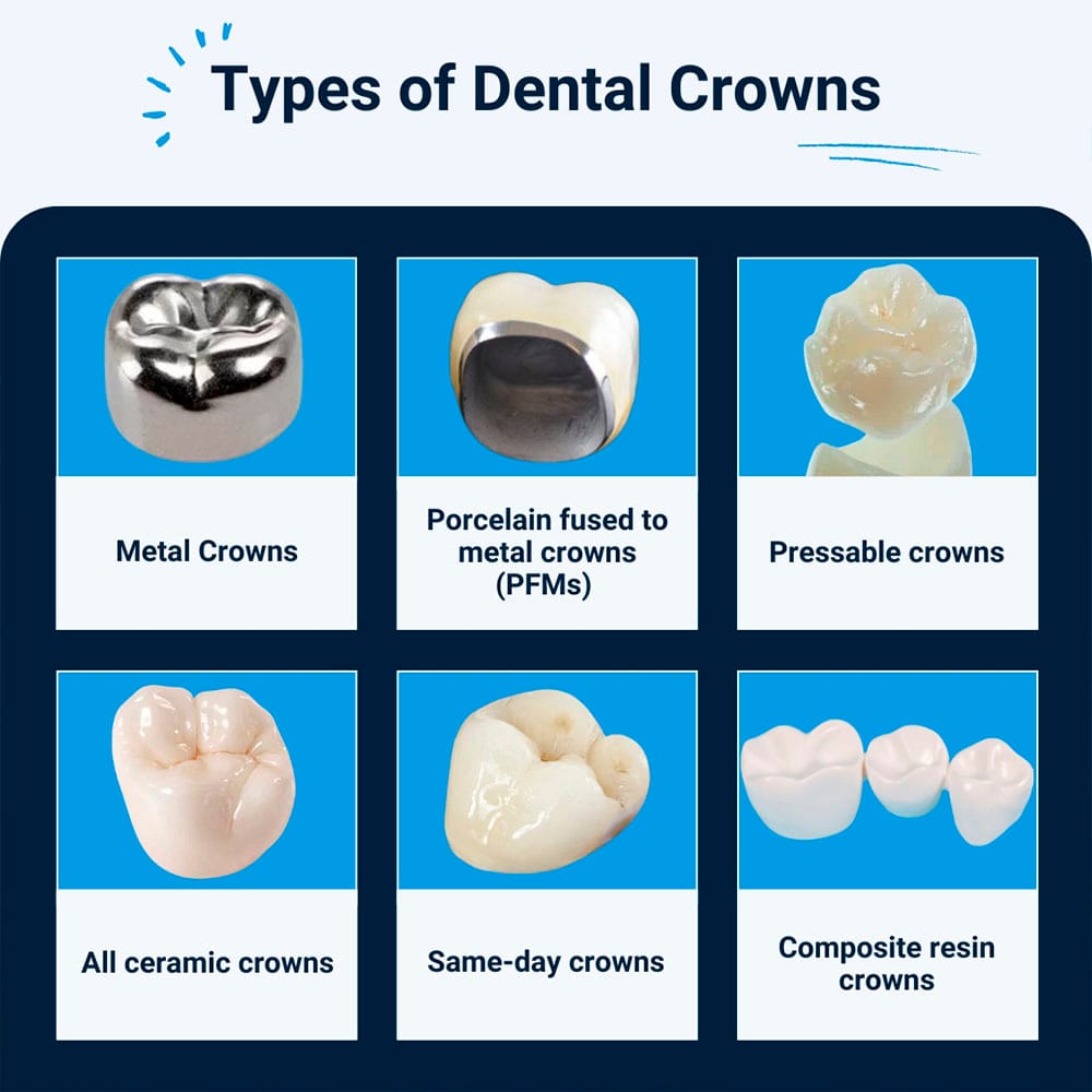 Types of Dental Crowns