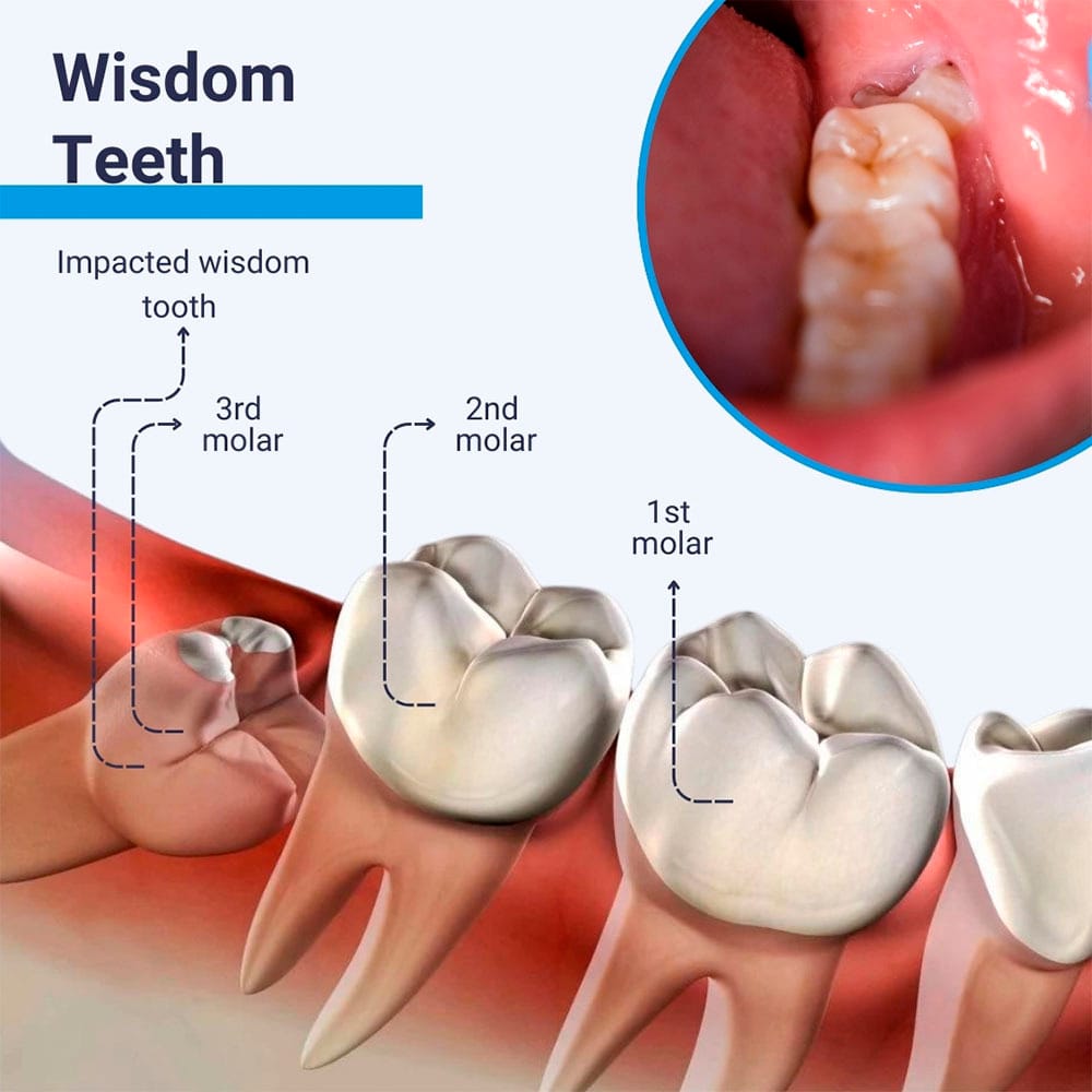 Wisdom Teeth