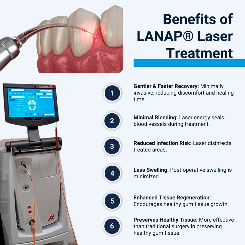 Benefits of LANAP Laser Treatment