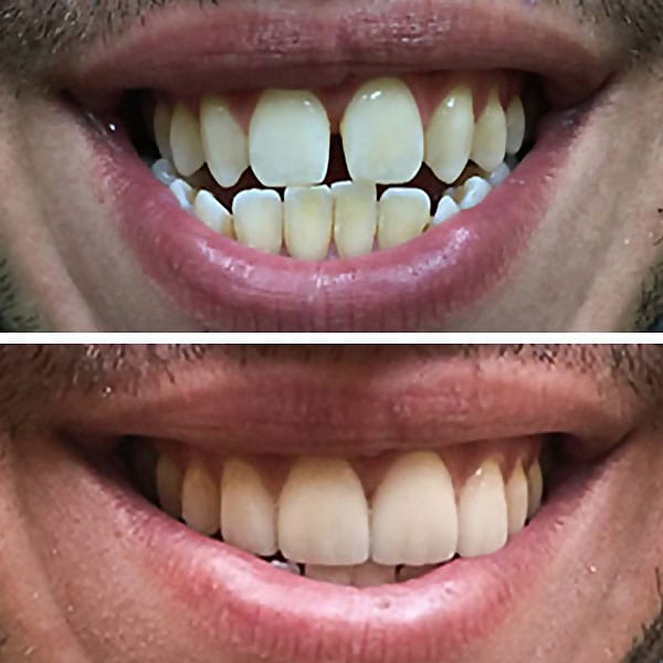 Cosmetic Dentistry Before After Results - Case 2