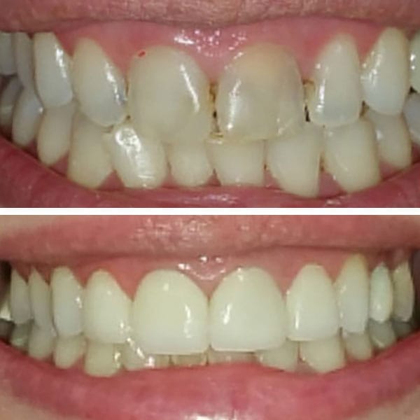 Cosmetic Dentistry Before After Results - Case 3