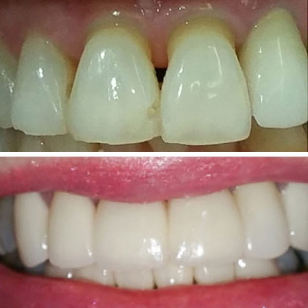 Cosmetic Dentistry Before After Results - Case 4