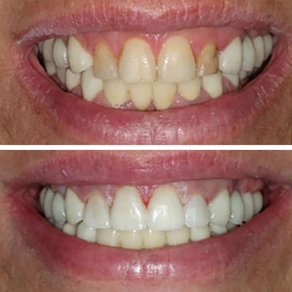 Cosmetic Dentistry Before After Results - Case 5