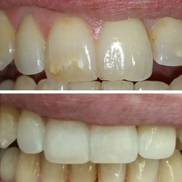 Cosmetic Dentistry Before After Results