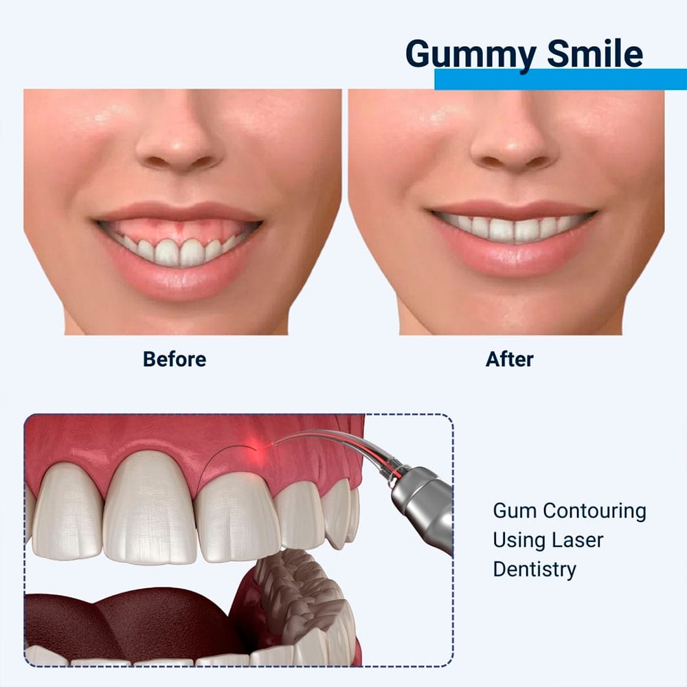 Gummy Smile