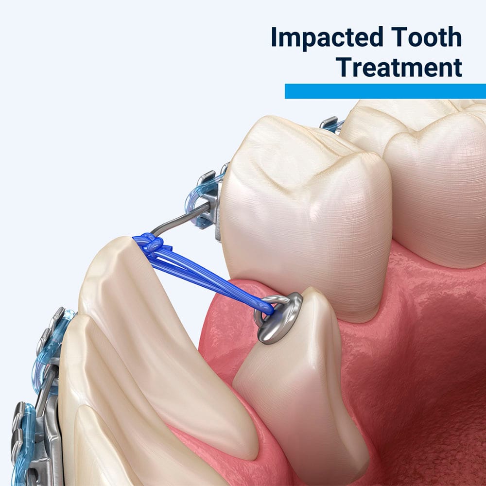 Impacted Tooth Treatment