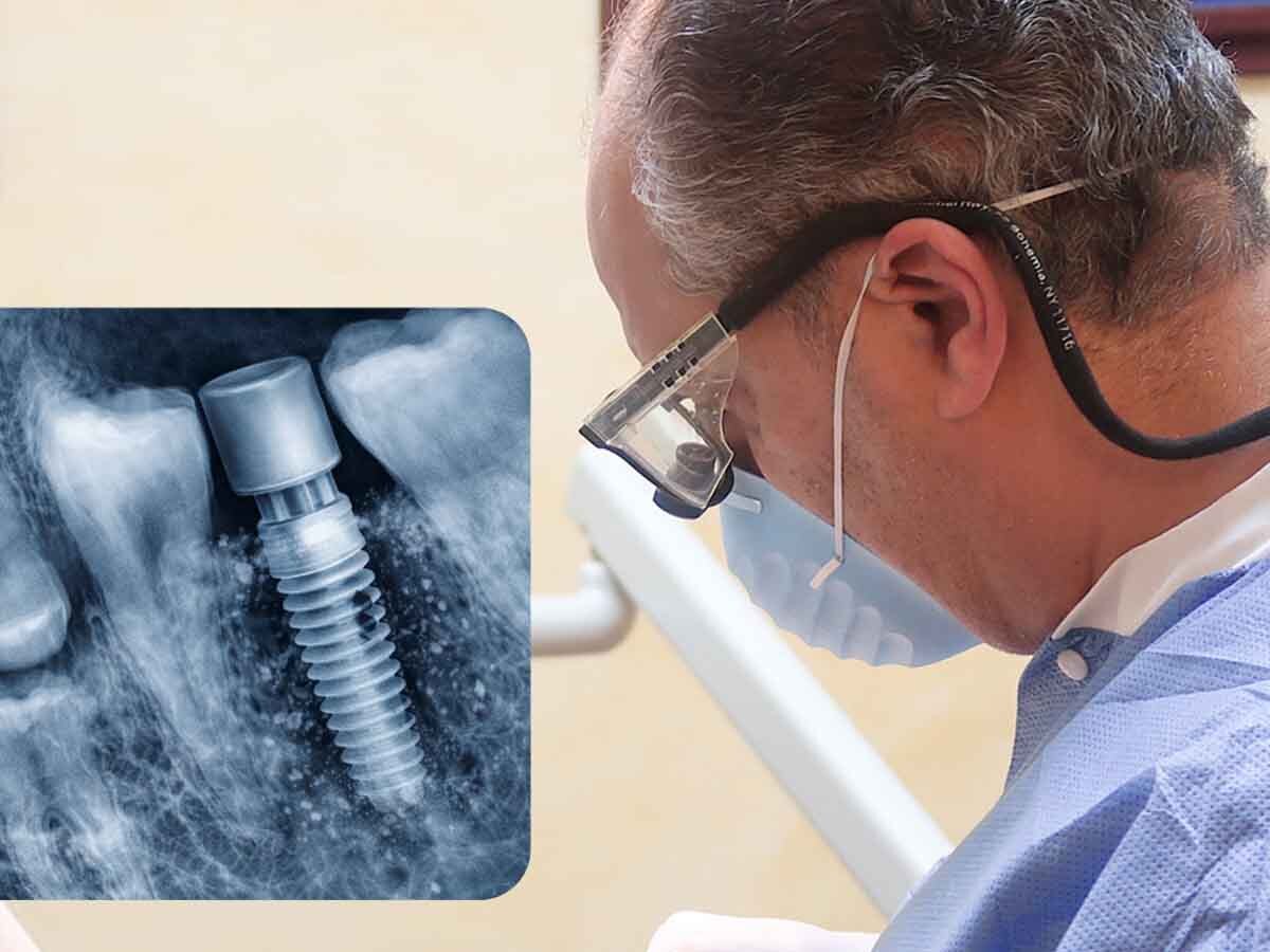 Dental Implant Complications Xray Clinical Evaluation
